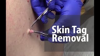 Skin Tag Removal  Dr Derm [upl. by Maressa899]