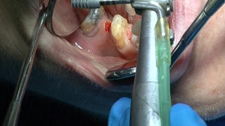 Implantes endodoncia coronas  Odontologia Multidisciplinar Dentistry Multidisciplinary [upl. by Esaj879]