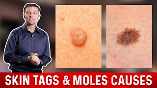 What Causes Skin Tags and Moles – DrBerg [upl. by Hurwitz]