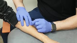 Dry Needling for Tennis Elbow [upl. by Phillane]