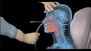 How to insert a nasogastric tube for NG intubation  3d animation [upl. by Majka936]