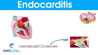 Endocarditis  causes symptoms pathophysiology diagnosis and treatment [upl. by Feodor]