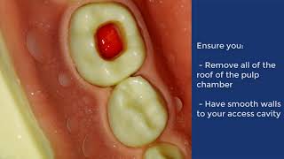 Pulpotomy of Deciduous Molar  QMUL [upl. by Binnings69]