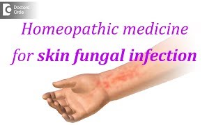 Homeopathic medicine for skin fungal infection  Dr Surekha Tiwari [upl. by Orwin]