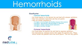 Hemorrhoids  causestypesclinical featuresdiagnosis and treatment [upl. by Calabrese147]