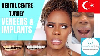 I HAD MY TEETH DONE IN TURKEY PART 1  DENTAL CENTRE TURKEY  Hollywood Smile Makeover  Veneers [upl. by Riatsila]