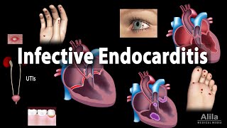 Infective Endocarditis Animation [upl. by Ynffit943]