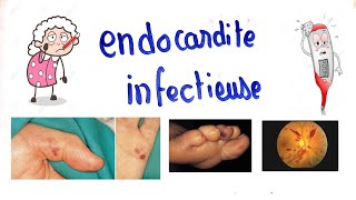 âť¤endocardite infectieuse [upl. by Eneja]