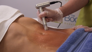 Stretch Mark Removal Treatment [upl. by Pollock]