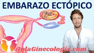 EMBARAZO ECTÓPICO CAUSAS SÍNTOMAS DIAGNÓSTICO BHCG ECOGRAFÍA  Ginecología y Obstetricia [upl. by Sidonius]