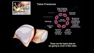 Talus Fractures  Everything You Need To Know  Dr Nabil Ebraheim [upl. by Loralyn432]