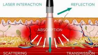 High Intensity Laser  Medical Effects [upl. by Hatcher404]