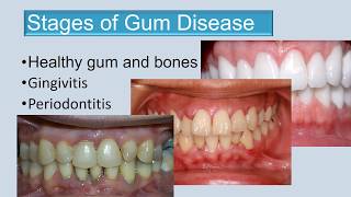 Stages of gum disease final edit 3 [upl. by Roosnam]