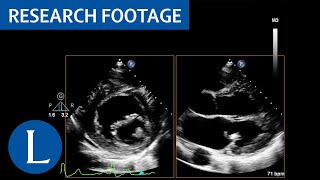 Mass attached to base of the posterior leaflet of the mitral LibmanSacks endocarditis 2 of 4 [upl. by Eugenia]