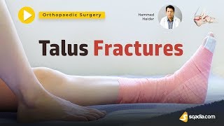 Talus Fractures  Orthopaedic Surgery Lectures  Medical Student  Trailer [upl. by Ovatsug]