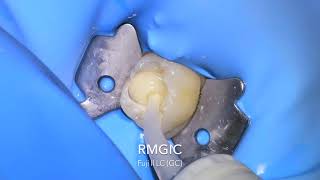 Primary molar pulpotomy and SSC [upl. by Pega]